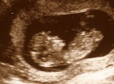 Midwives lose abortion case